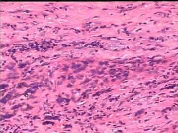 女/78岁 甲状腺肿块 IHC10-4-24图23