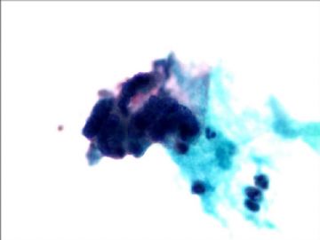 宫颈液基病例--002（有活检结果）图5