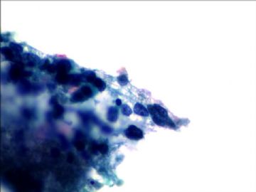 宫颈液基病例--002（有活检结果）图12