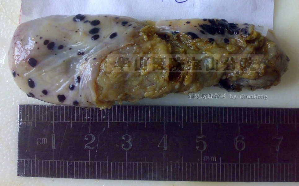 腹腔内大量黑色斑块，请帮忙诊断下图1