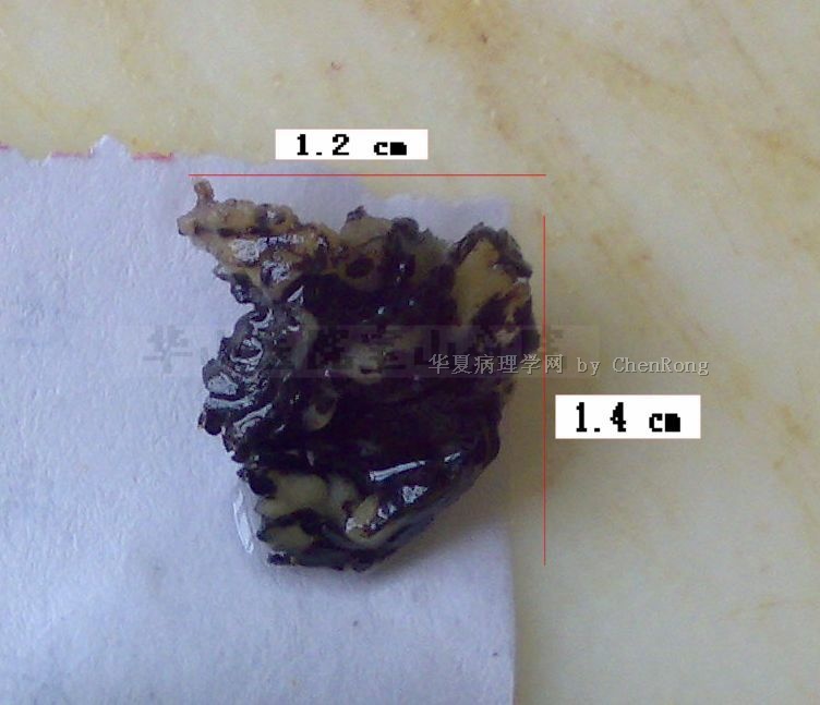 腹腔内大量黑色斑块，请帮忙诊断下图4