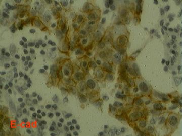 乳腺肿块，良性或恶性？(免疫组化结果公布)图27
