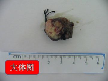 肺肿物。图1