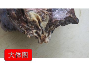 支气管肿物图1