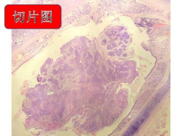 支气管肿物图2