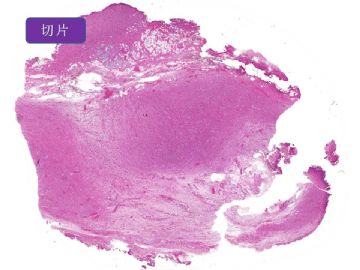附睾肿瘤图1