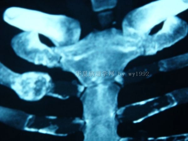 201004294右第二肋骨肿瘤图13 201004294右第二肋骨肿瘤图13