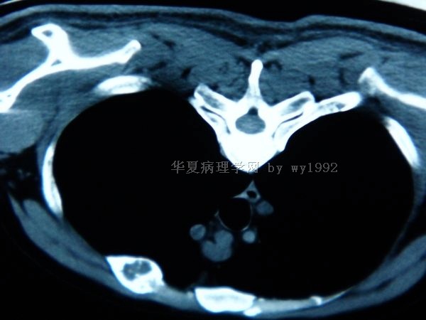 201004294右第二肋骨肿瘤图16 201004294右第二肋骨肿瘤图16