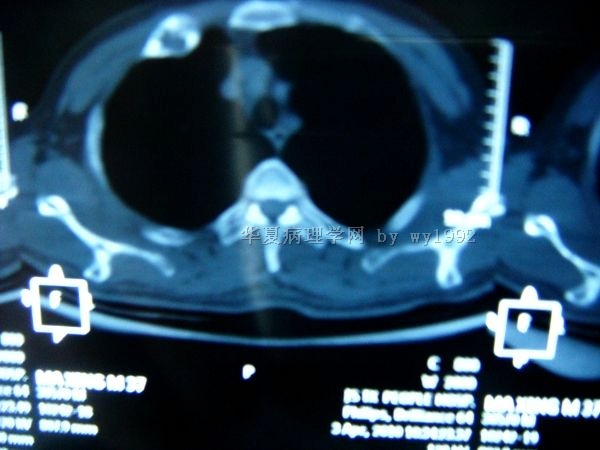 201004294右第二肋骨肿瘤图17 201004294右第二肋骨肿瘤图17