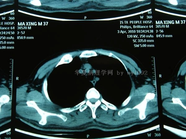 201004294右第二肋骨肿瘤图20 201004294右第二肋骨肿瘤图20
