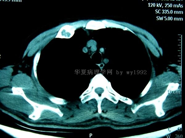 201004294右第二肋骨肿瘤图21 201004294右第二肋骨肿瘤图21