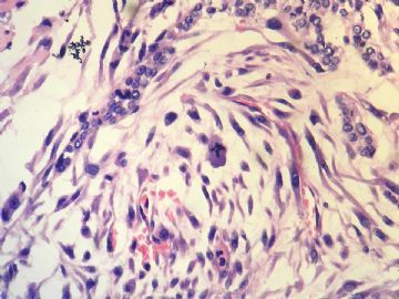 甲状腺恶性肿瘤分类？免疫组化结果公布！图10