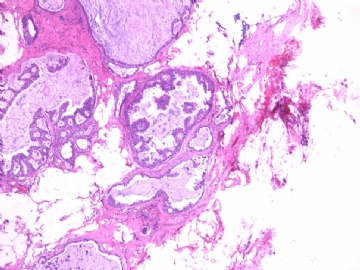 女性/62岁。 右乳腺肿块 0.8cm, 诊断？(IHC10-8-28)图3