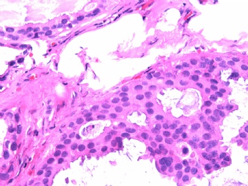 女性/62岁。 右乳腺肿块 0.8cm, 诊断？(IHC10-8-28)图8