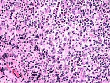 男性/15岁，骶骨肿瘤，影像学诊断Langerhan's Histiocytosis ，IHC10-9-5图9