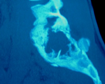 男性/15岁，骶骨肿瘤，影像学诊断Langerhan's Histiocytosis ，IHC10-9-5图14