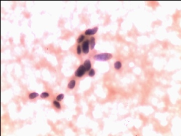 甲状腺肿块穿刺物图7