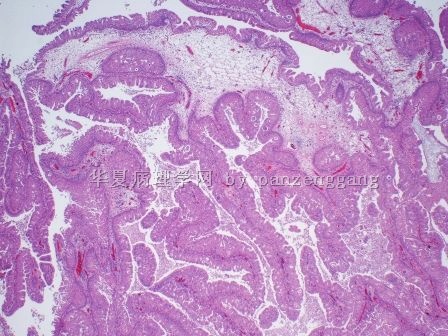 Nasal polyp图1
