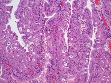 Nasal polyp图2