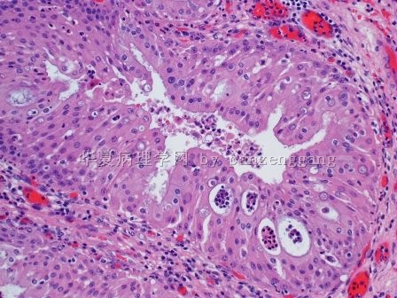 Nasal polyp图3