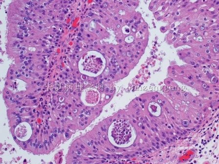 Nasal polyp图4