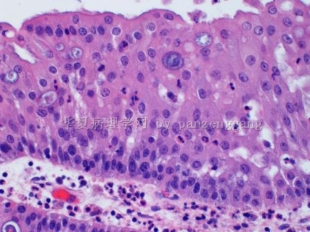 Nasal polyp图6