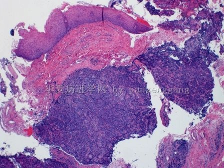 Pharyngeal lesion图1