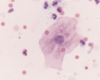 宫颈液基，ascus?lish?滴虫？图2