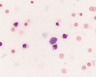 宫颈液基，ascus?lish?滴虫？图5