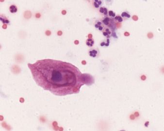 宫颈液基，ascus?lish?滴虫？图10