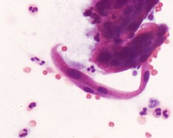 宫颈液基，ascus?lish?滴虫？图11