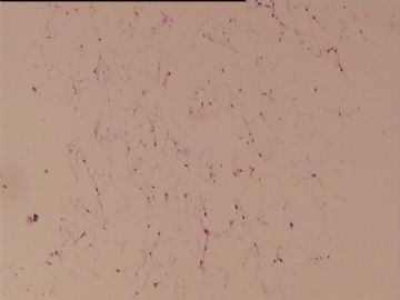 腹膜后肿（物脂肪瘤），请会诊。图1