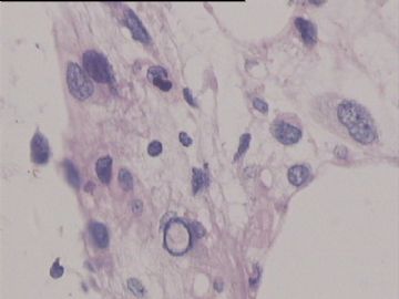 腹膜后肿（物脂肪瘤），请会诊。图19