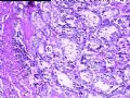 甲状腺图5