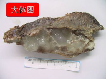 肋骨肿物图2